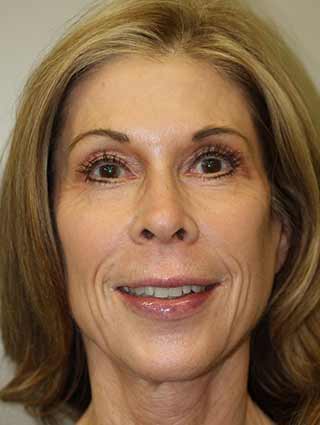 Aesthetic surgery patient looking younger after facelift surgery- front view, full face