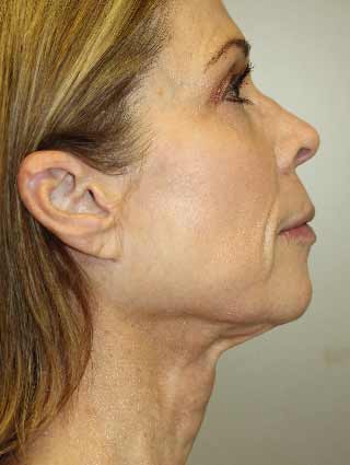 Aesthetic surgery patient after facelift surgery- profile view, side of face