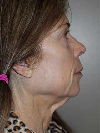 Facelift patient before surgery- profile view, side of face