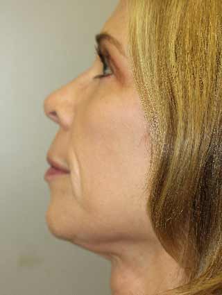 Aesthetic surgery patient after facelift surgery- profile view, side of face