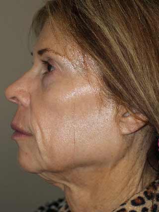 Facelift patient before surgery- profile view, side of face